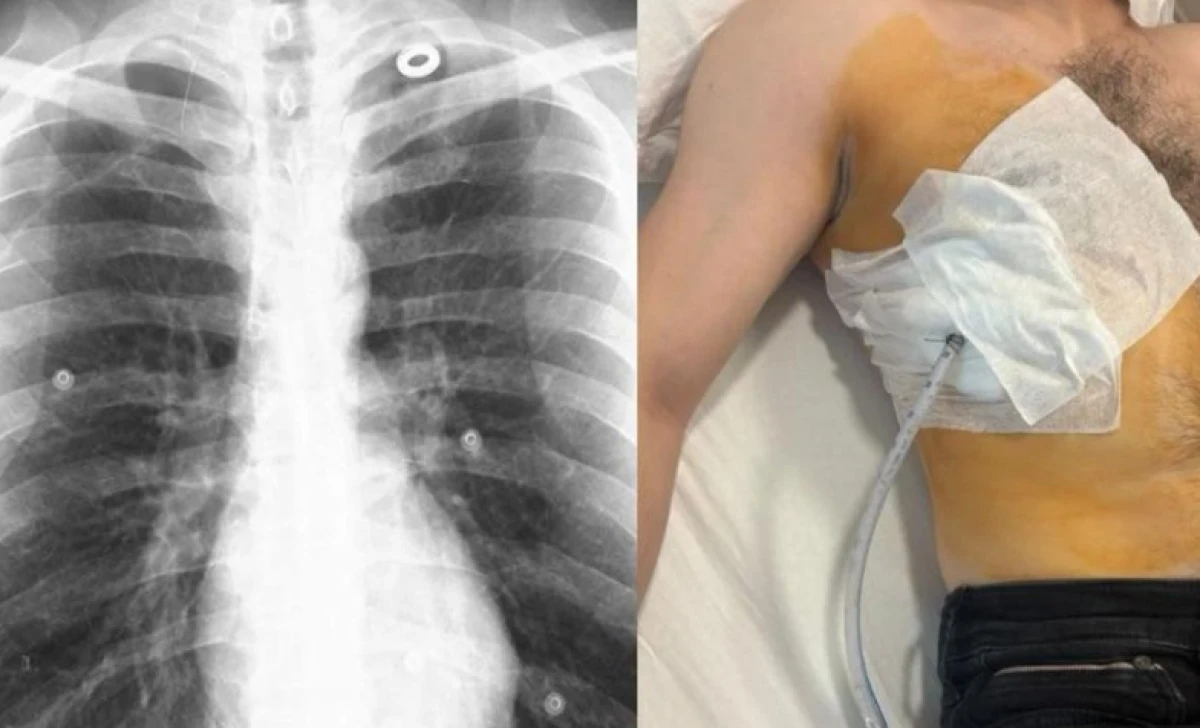 Taburcu edilen hastanın akciğerleri s&ouml;nd&uuml;